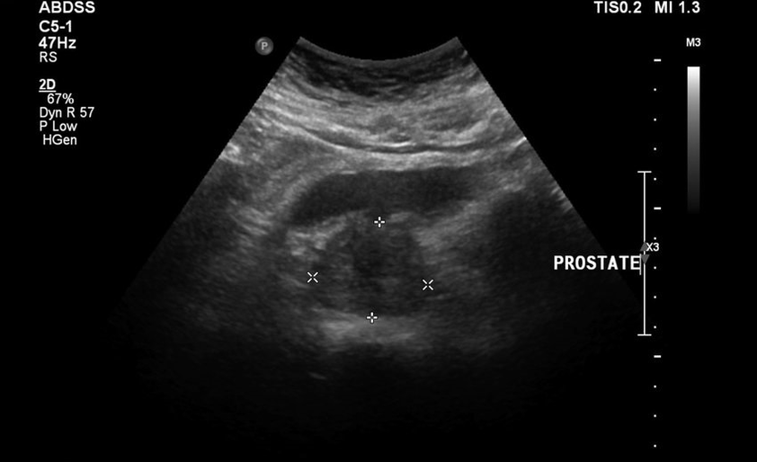 Prostatite ad ultrasuoni prima di prendere Zxcvbnmqwert