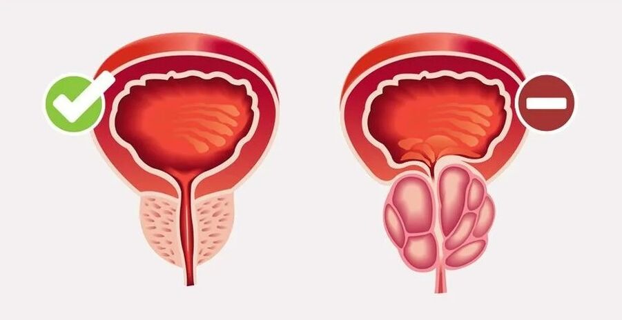 Prostatite negli uomini