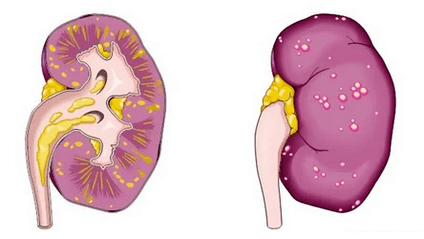 A cosa porta la prostatite acuta