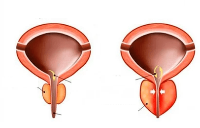 Cos'è la prostatite acuta