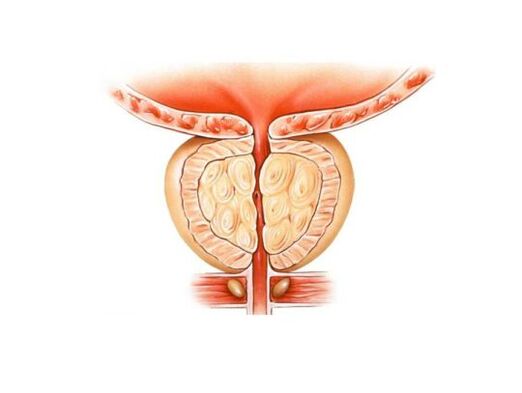 Aumento della prostata con prostatite