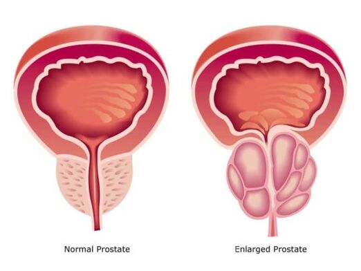 Prostata normale e allargata